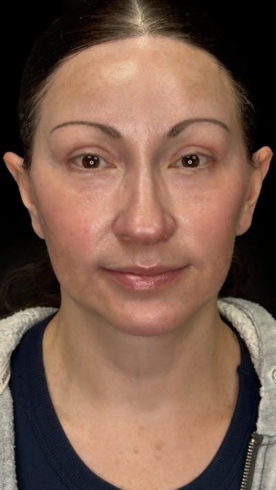 Brow Lift Before & After Gallery - Patient 231047 - Image 1