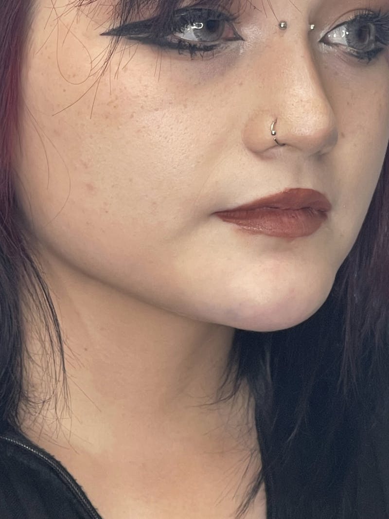 Chin Dimple Surgery Before & After Gallery - Patient 424858 - Image 10