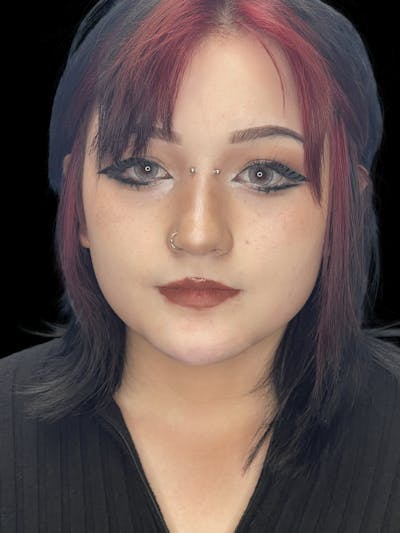 Chin Dimple Surgery Before & After Gallery - Patient 424858 - Image 2