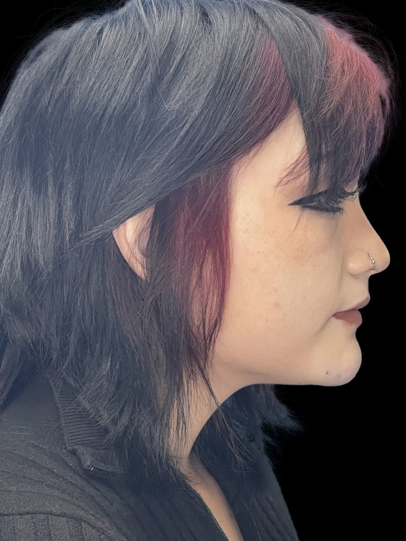 Chin Dimple Surgery Before & After Gallery - Patient 424858 - Image 6