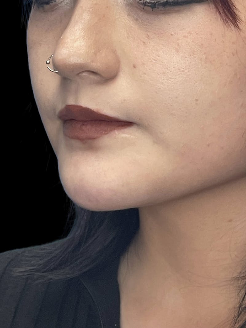 Chin Dimple Surgery Before & After Gallery - Patient 424858 - Image 8