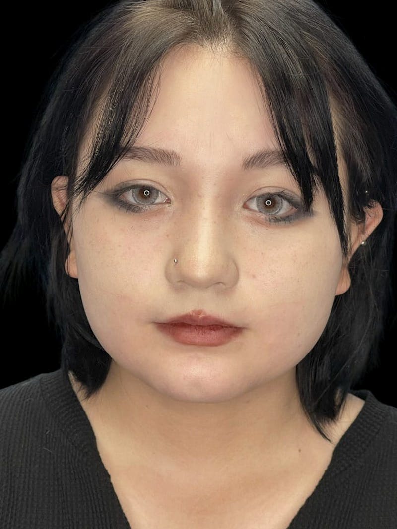 Chin Dimple Surgery Before & After Gallery - Patient 424858 - Image 1