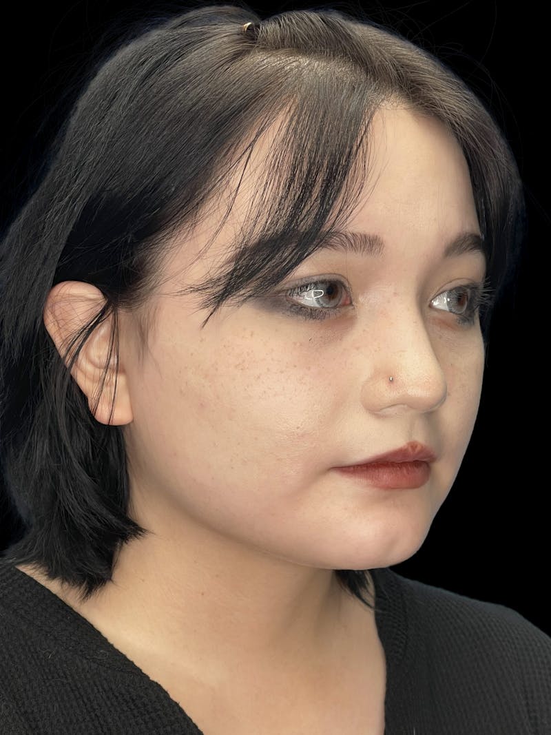 Chin Dimple Surgery Before & After Gallery - Patient 424858 - Image 3