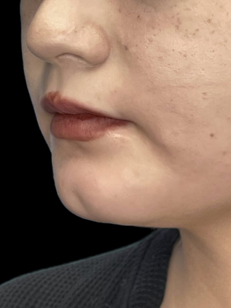 Chin Dimple Surgery Before & After Gallery - Patient 424858 - Image 7