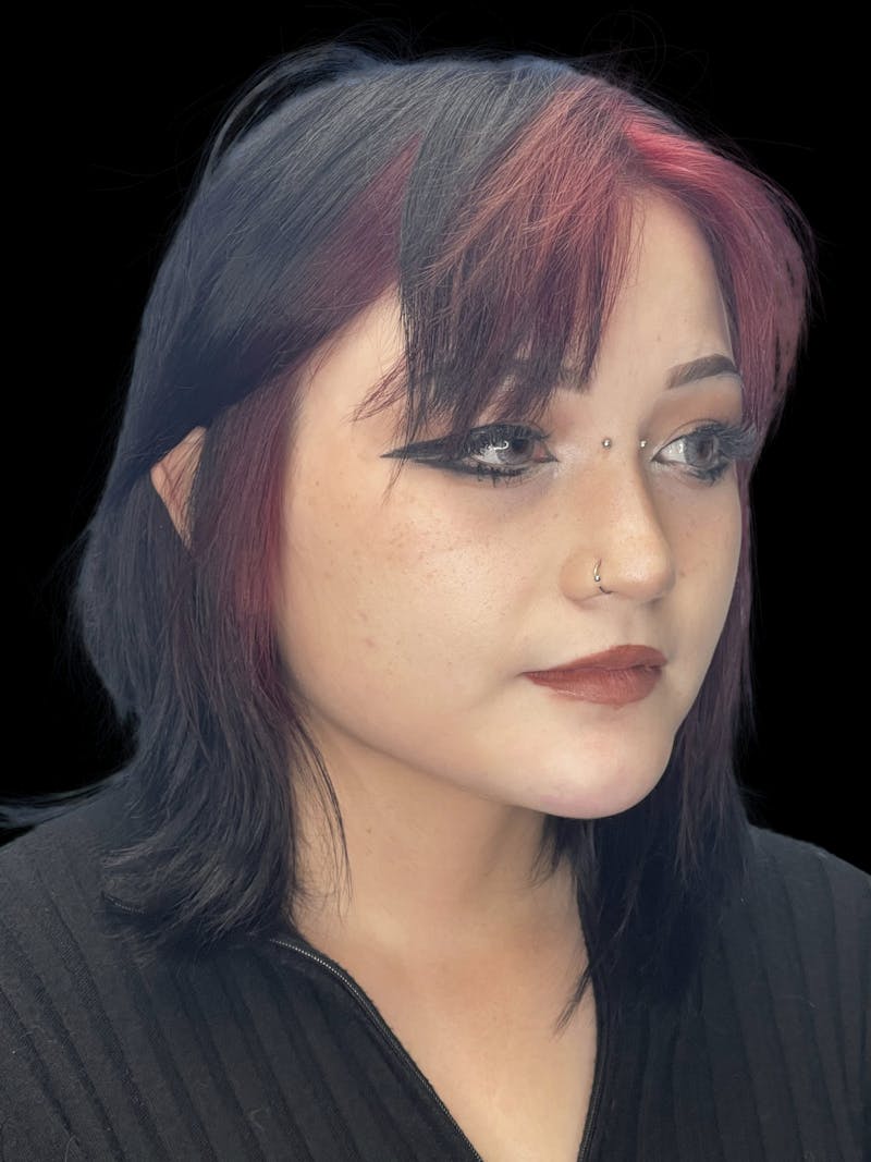 Chin Dimple Surgery Before & After Gallery - Patient 424858 - Image 4