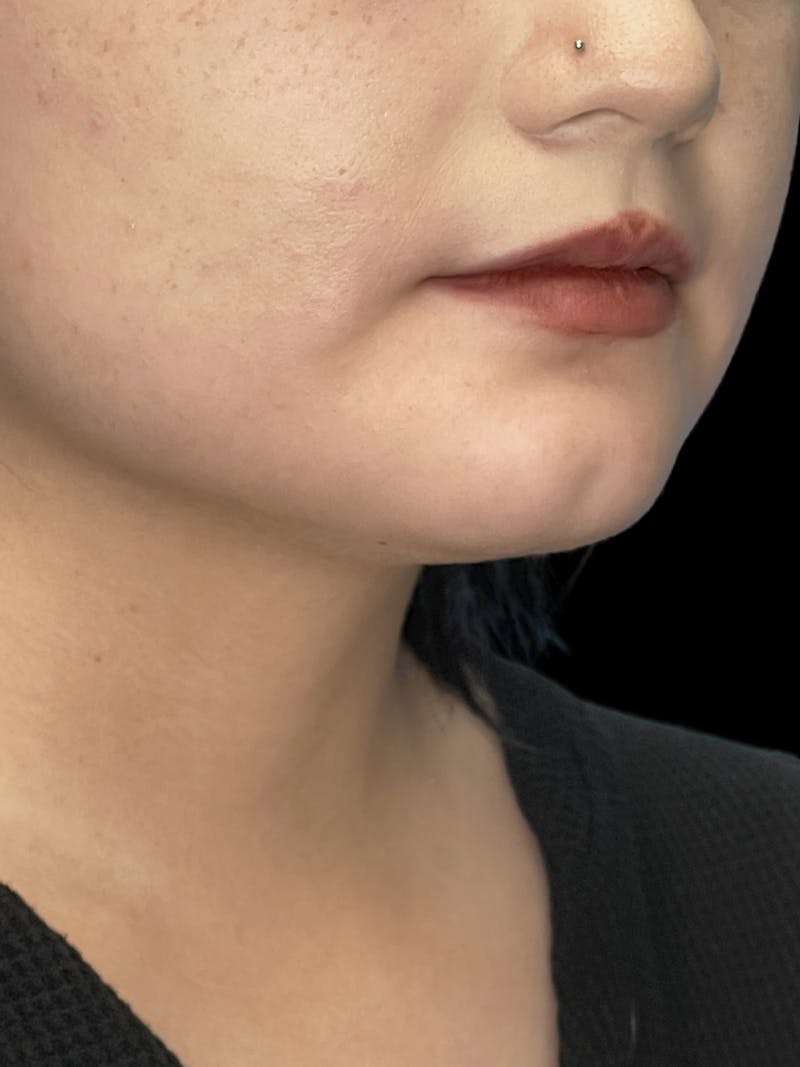 Chin Dimple Surgery Before & After Gallery - Patient 424858 - Image 9