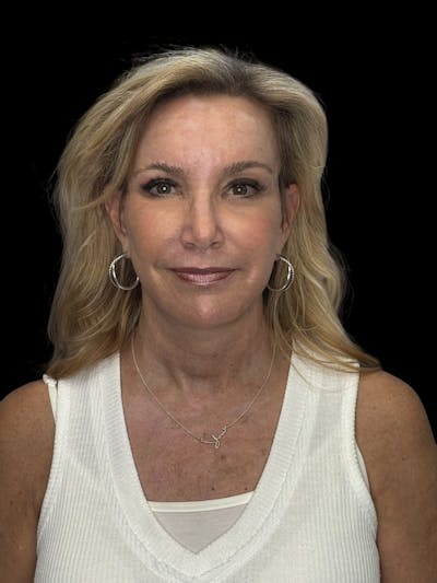 ContourLift Before & After Gallery - Patient 329994 - Image 2