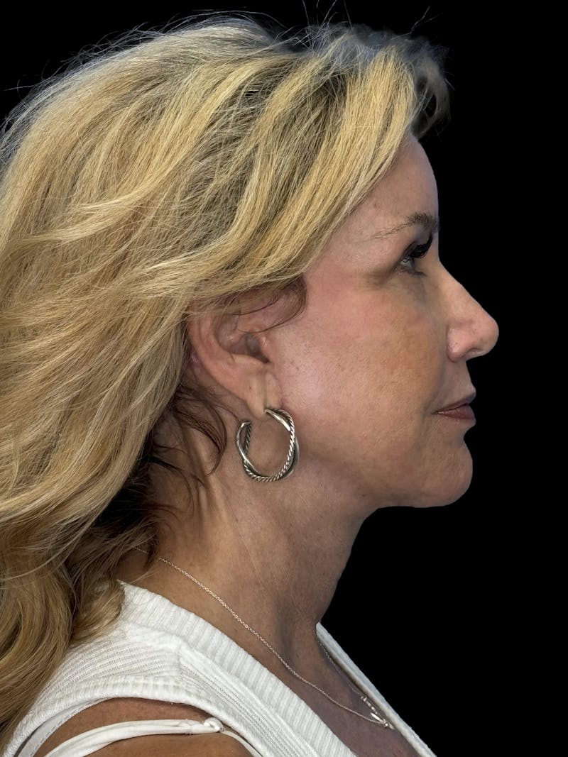 ContourLift Before & After Gallery - Patient 329994 - Image 12