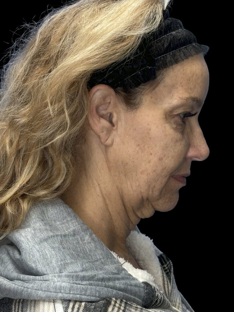 ContourLift Before & After Gallery - Patient 329994 - Image 9