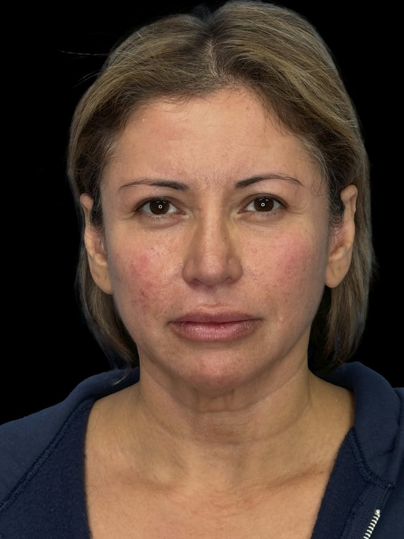 ContourLift Before & After Gallery - Patient 150055 - Image 1