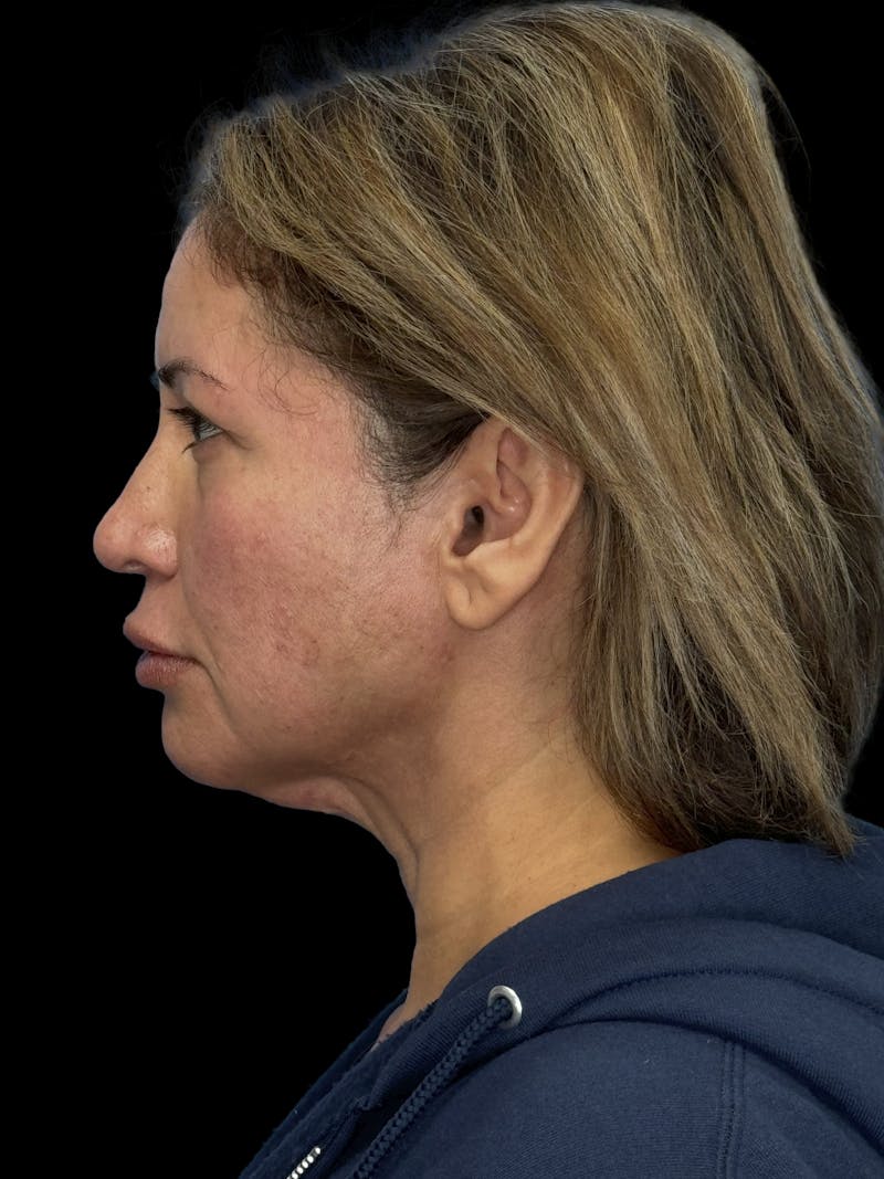 ContourLift Before & After Gallery - Patient 150055 - Image 7