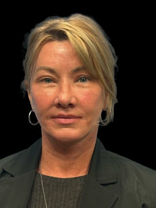 Deep Plane Facelift 50s Before & After Gallery - Patient 118984 - Image 2