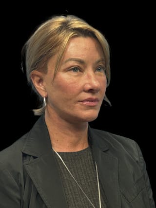 Deep Plane Facelift 50s Before & After Gallery - Patient 118984 - Image 8