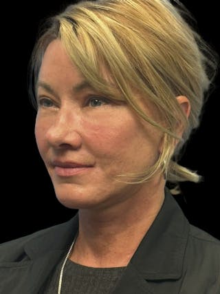 Deep Plane Facelift 50s Before & After Gallery - Patient 118984 - Image 4