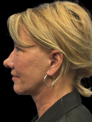 Deep Plane Facelift 50s Before & After Gallery - Patient 118984 - Image 6