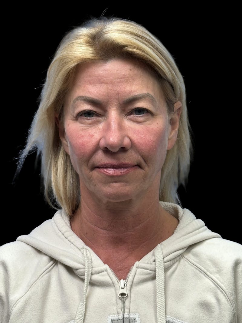 ContourLift Before & After Gallery - Patient 351601 - Image 1