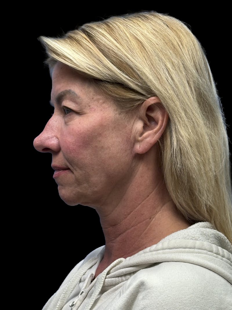 ContourLift Before & After Gallery - Patient 351601 - Image 5