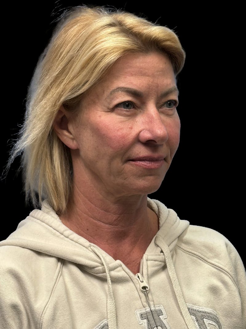 ContourLift Before & After Gallery - Patient 351601 - Image 7