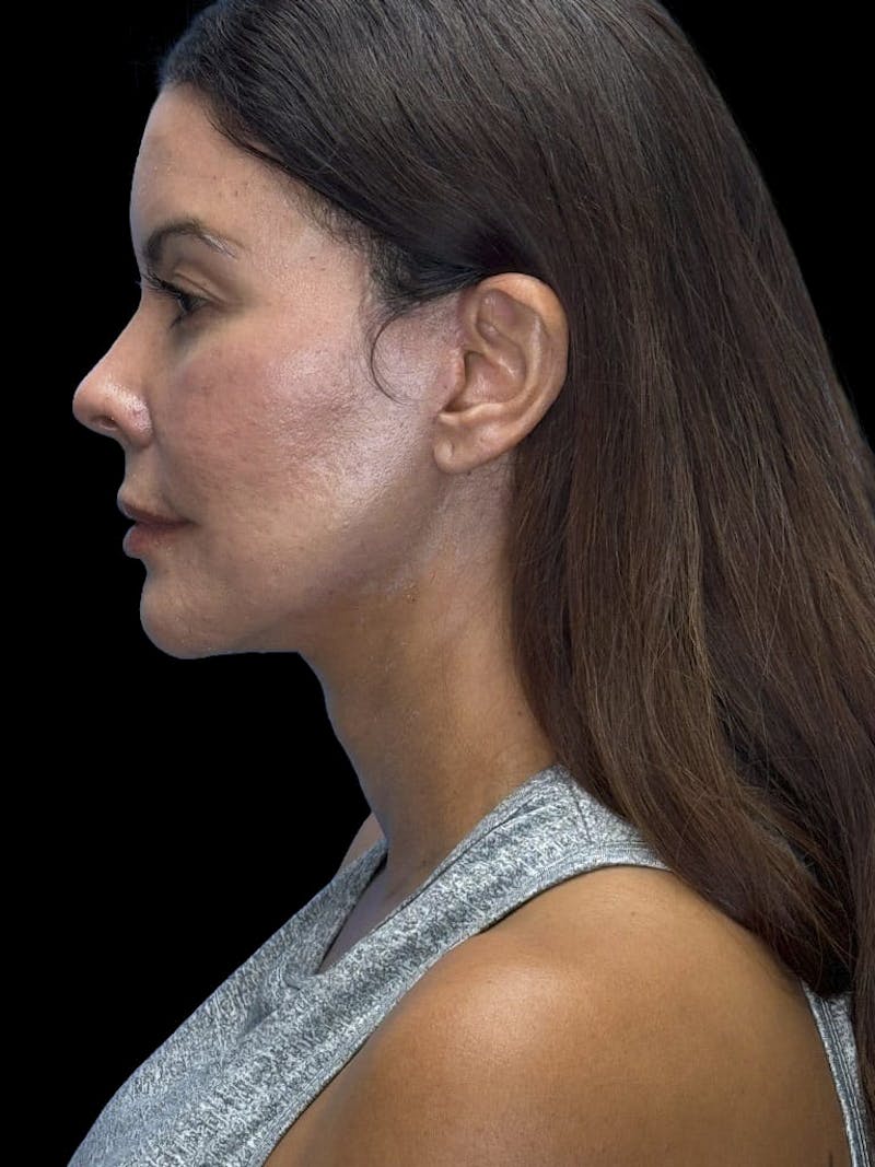ContourLift Before & After Gallery - Patient 279744 - Image 6