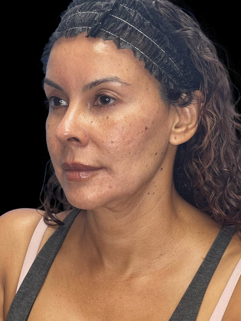 ContourLift Before & After Gallery - Patient 279744 - Image 3