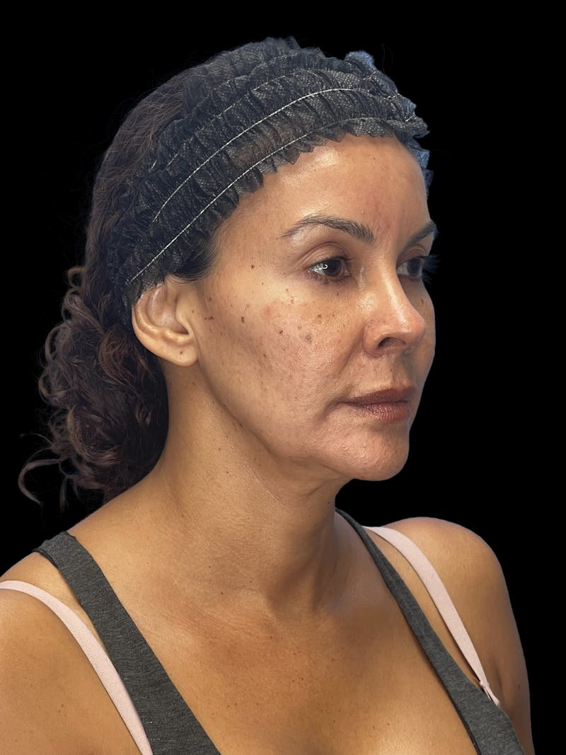 ContourLift Before & After Gallery - Patient 279744 - Image 7