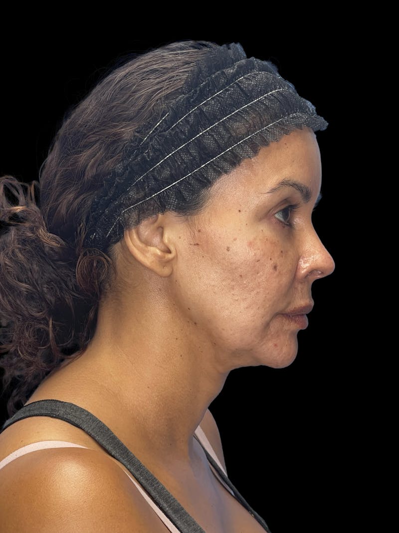 ContourLift Before & After Gallery - Patient 279744 - Image 9