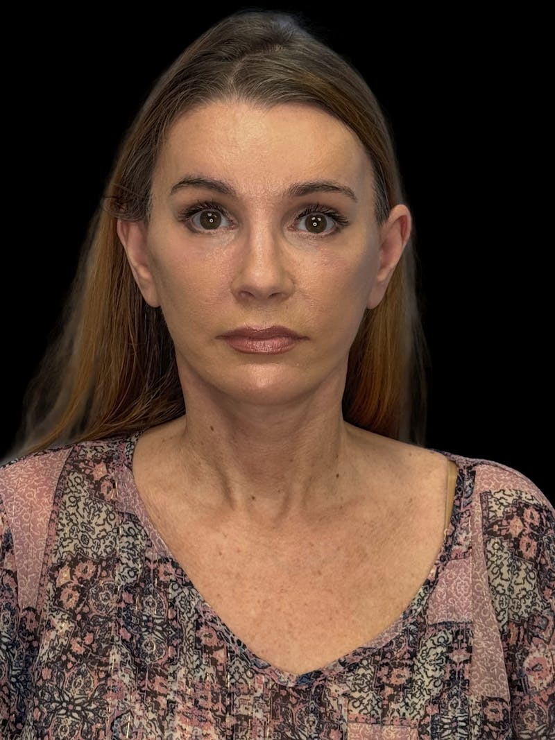 ContourLift Before & After Gallery - Patient 410035 - Image 2