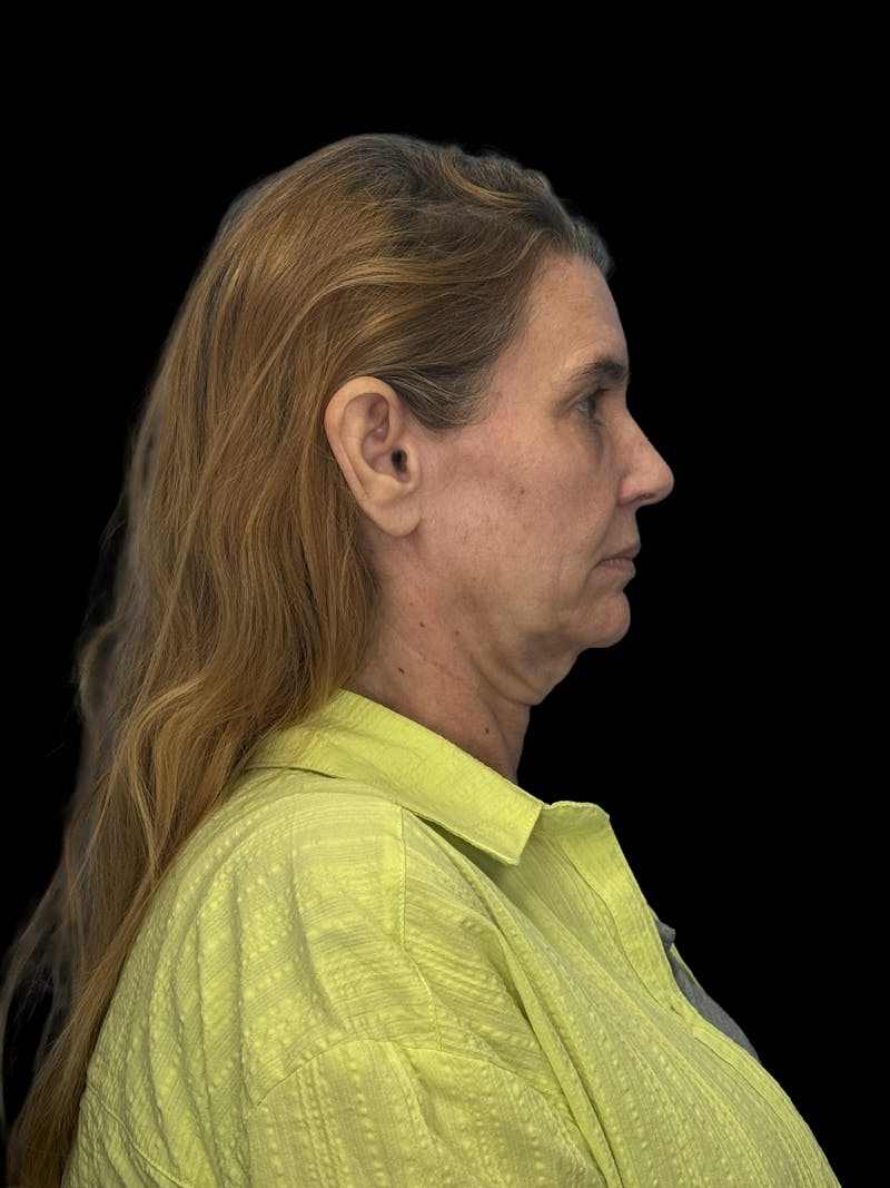 ContourLift Before & After Gallery - Patient 410035 - Image 5