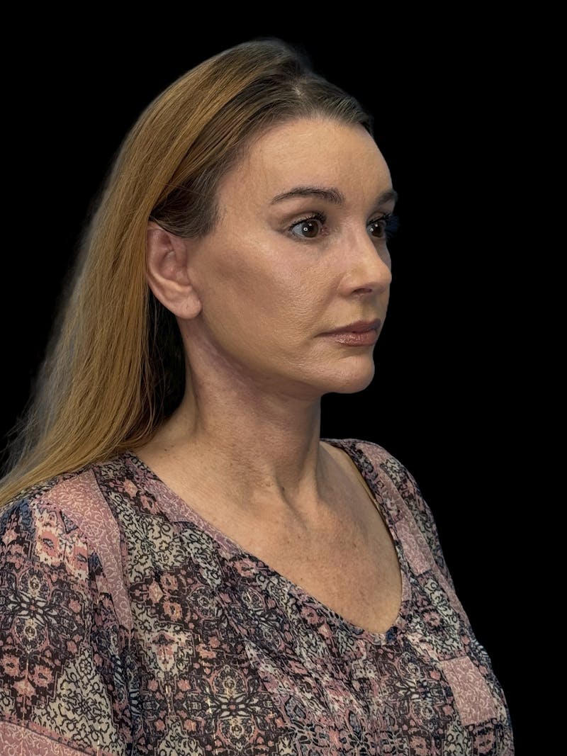 ContourLift Before & After Gallery - Patient 410035 - Image 4
