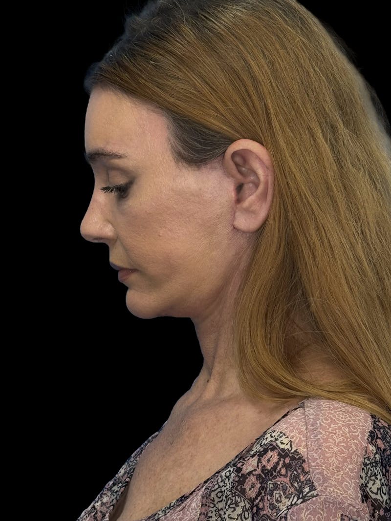 ContourLift Before & After Gallery - Patient 410035 - Image 10