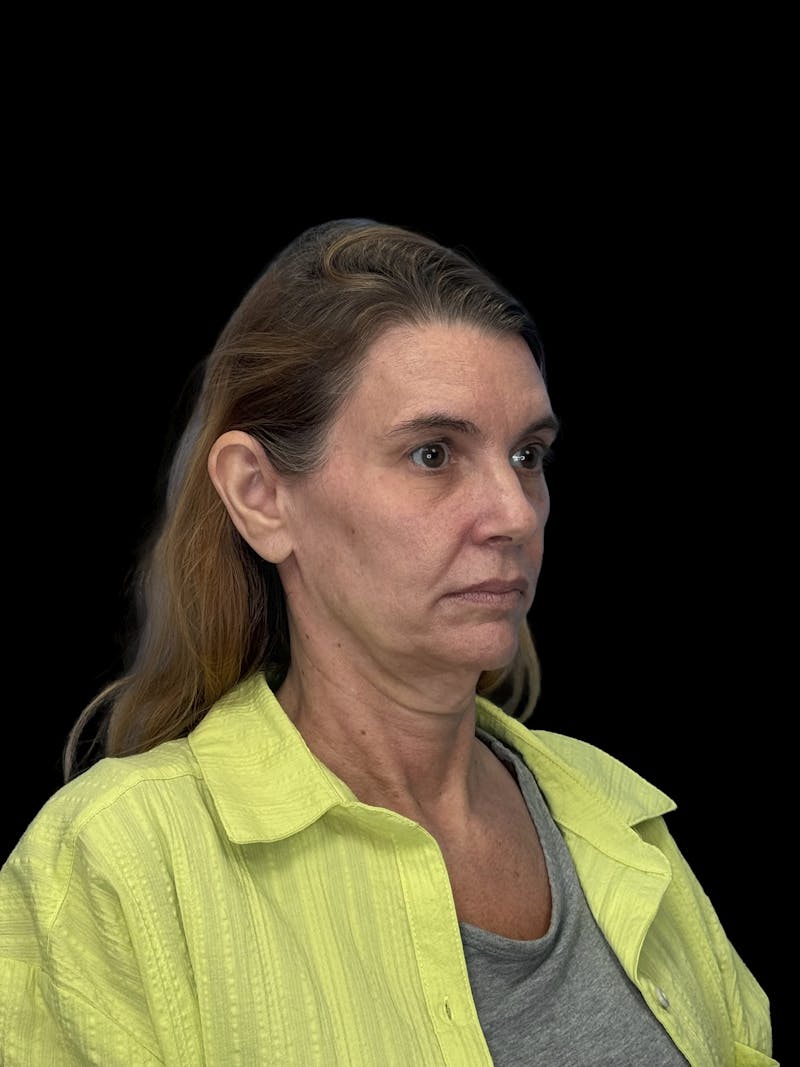 ContourLift Before & After Gallery - Patient 410035 - Image 3