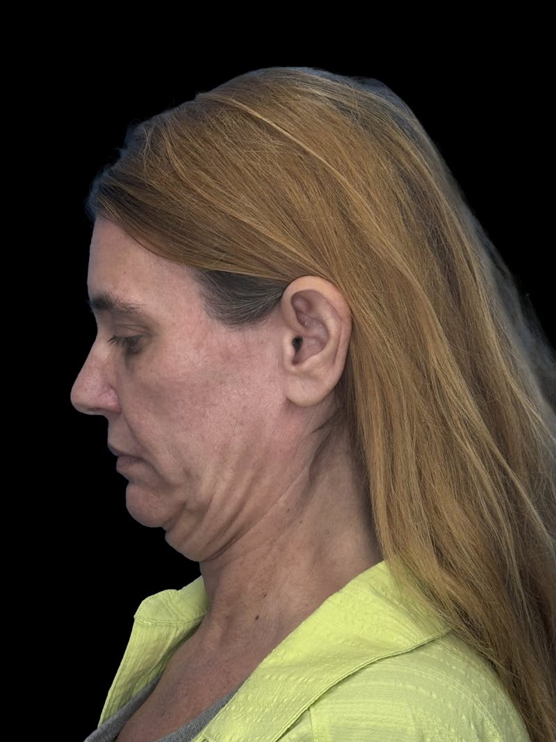 ContourLift Before & After Gallery - Patient 410035 - Image 9