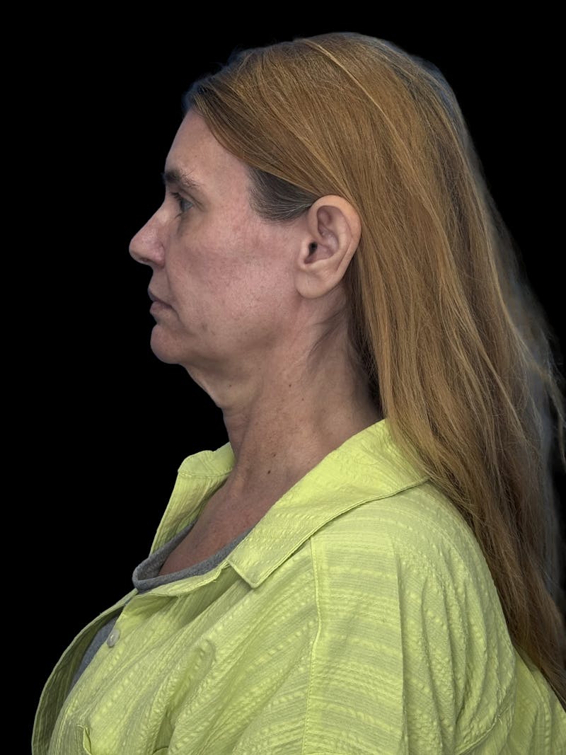 ContourLift Before & After Gallery - Patient 410035 - Image 7