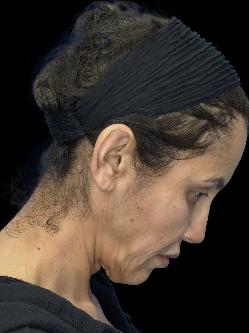 ContourLift Before & After Gallery - Patient 227072 - Image 9