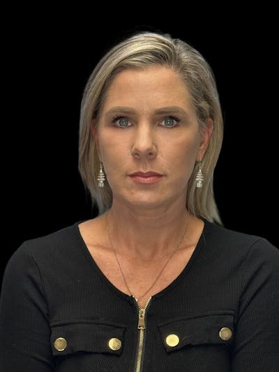 ContourLift Before & After Gallery - Patient 247846 - Image 2