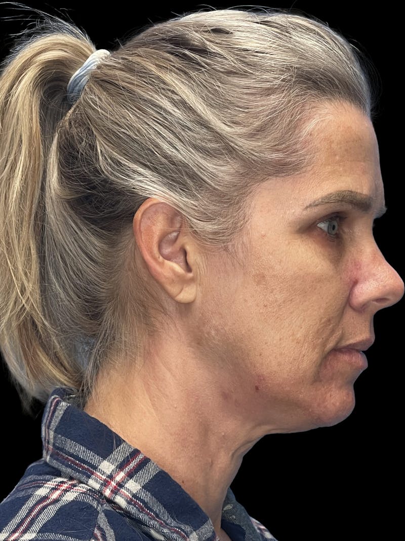 ContourLift Before & After Gallery - Patient 247846 - Image 9
