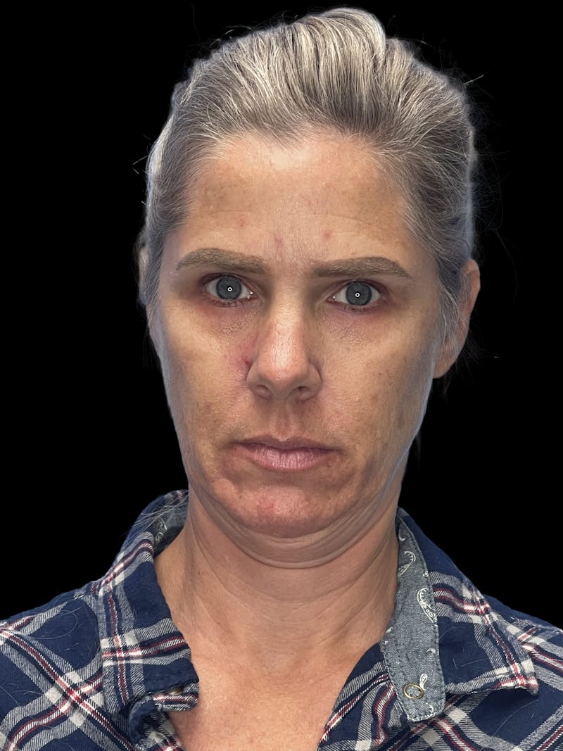 ContourLift Before & After Gallery - Patient 247846 - Image 1