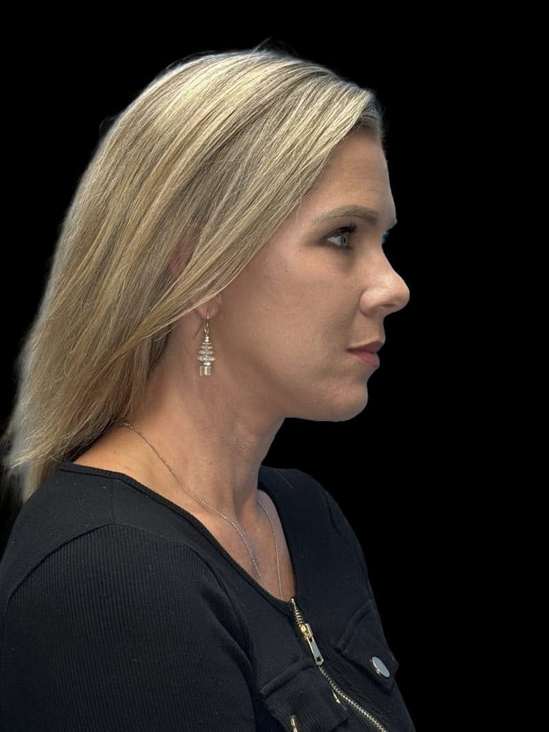 ContourLift Before & After Gallery - Patient 247846 - Image 10