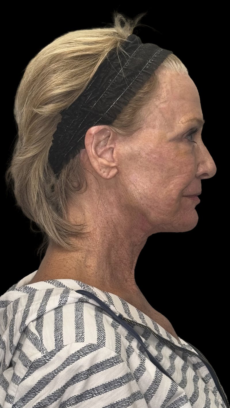 ContourLift Before & After Gallery - Patient 318549 - Image 10