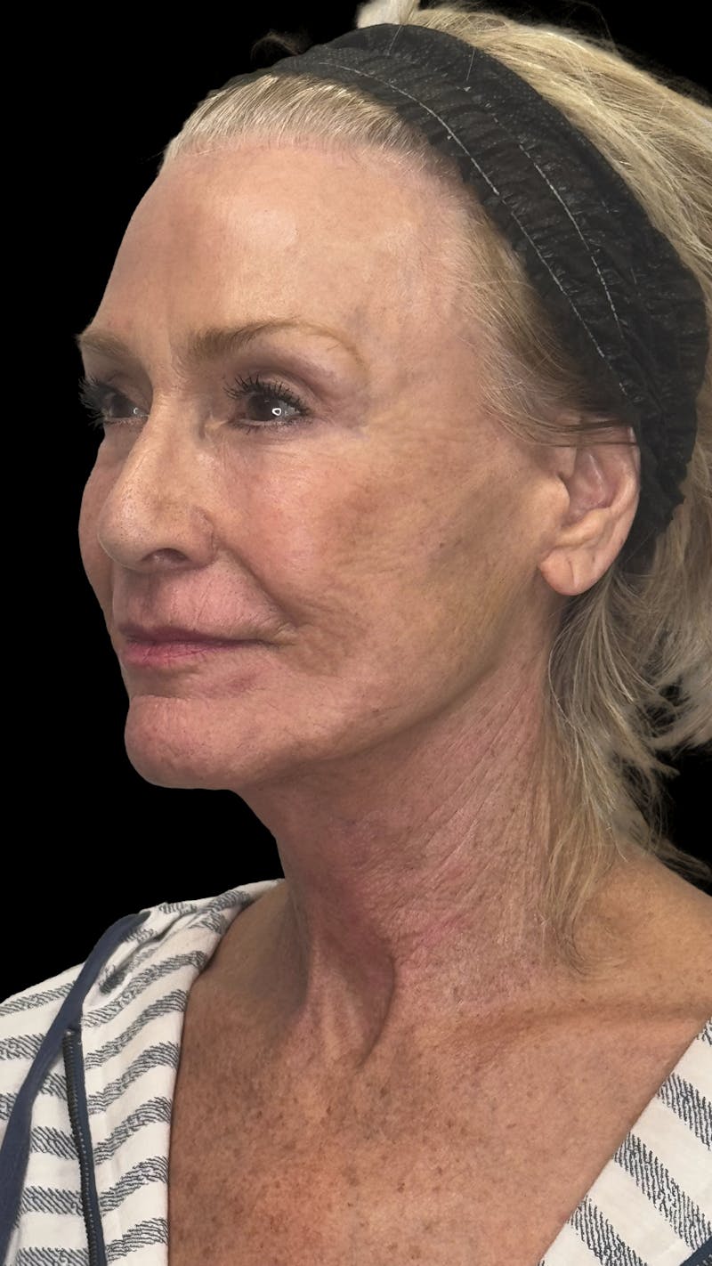 ContourLift Before & After Gallery - Patient 318549 - Image 6