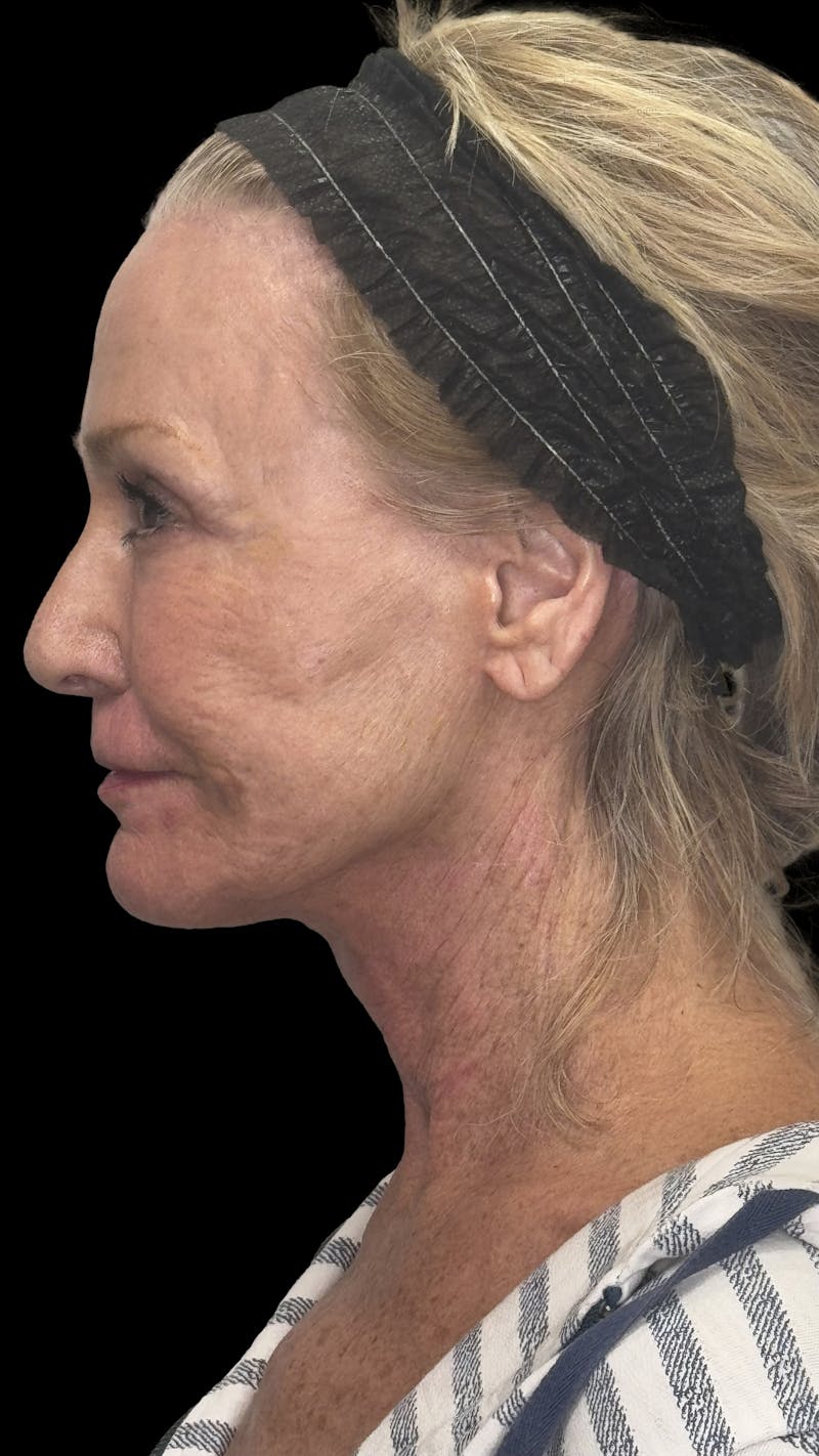 ContourLift Before & After Gallery - Patient 318549 - Image 8