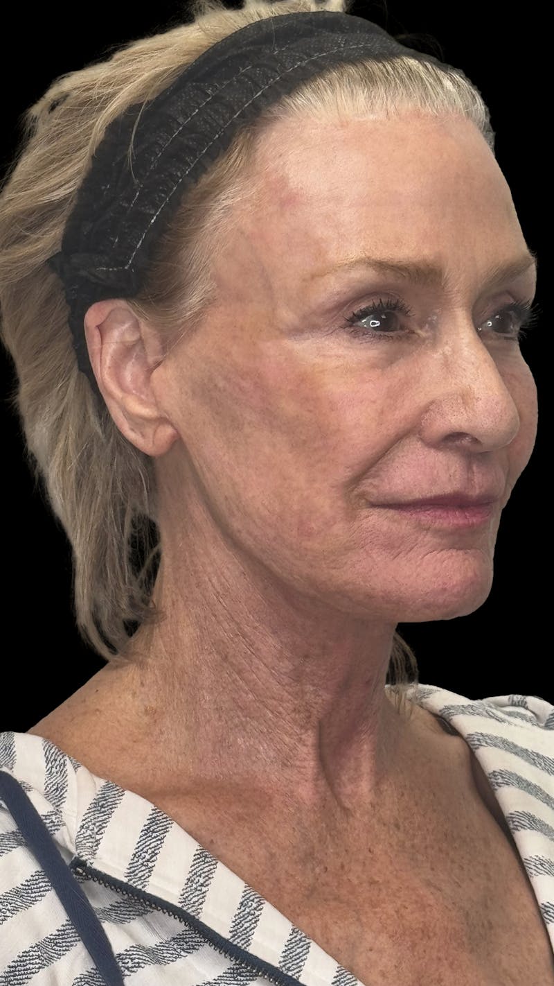 ContourLift Before & After Gallery - Patient 318549 - Image 4