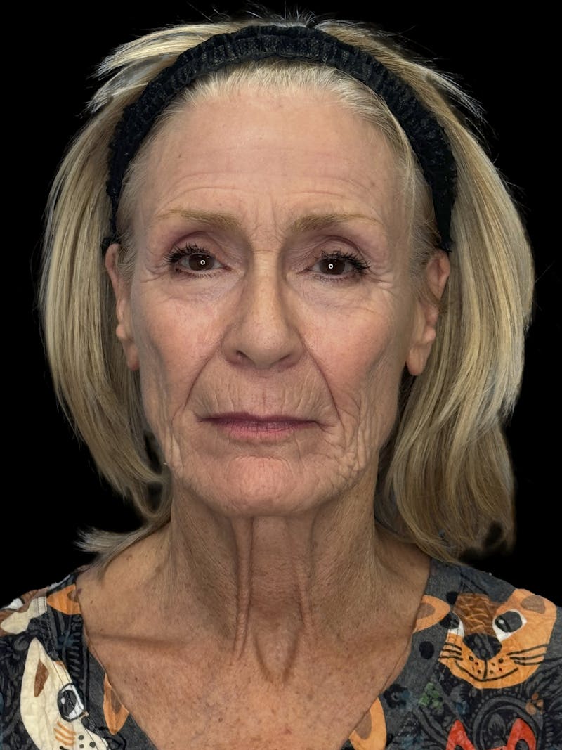 ContourLift Before & After Gallery - Patient 318549 - Image 1