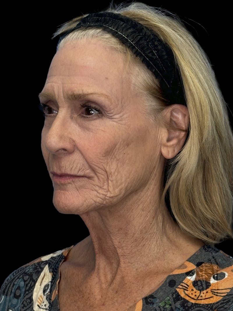ContourLift Before & After Gallery - Patient 318549 - Image 5