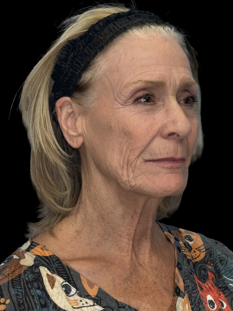 ContourLift Before & After Gallery - Patient 318549 - Image 3