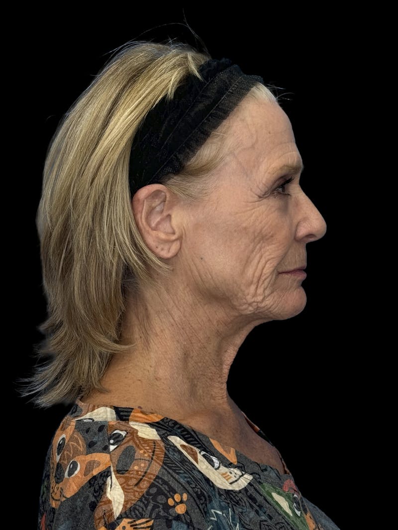 ContourLift Before & After Gallery - Patient 318549 - Image 9