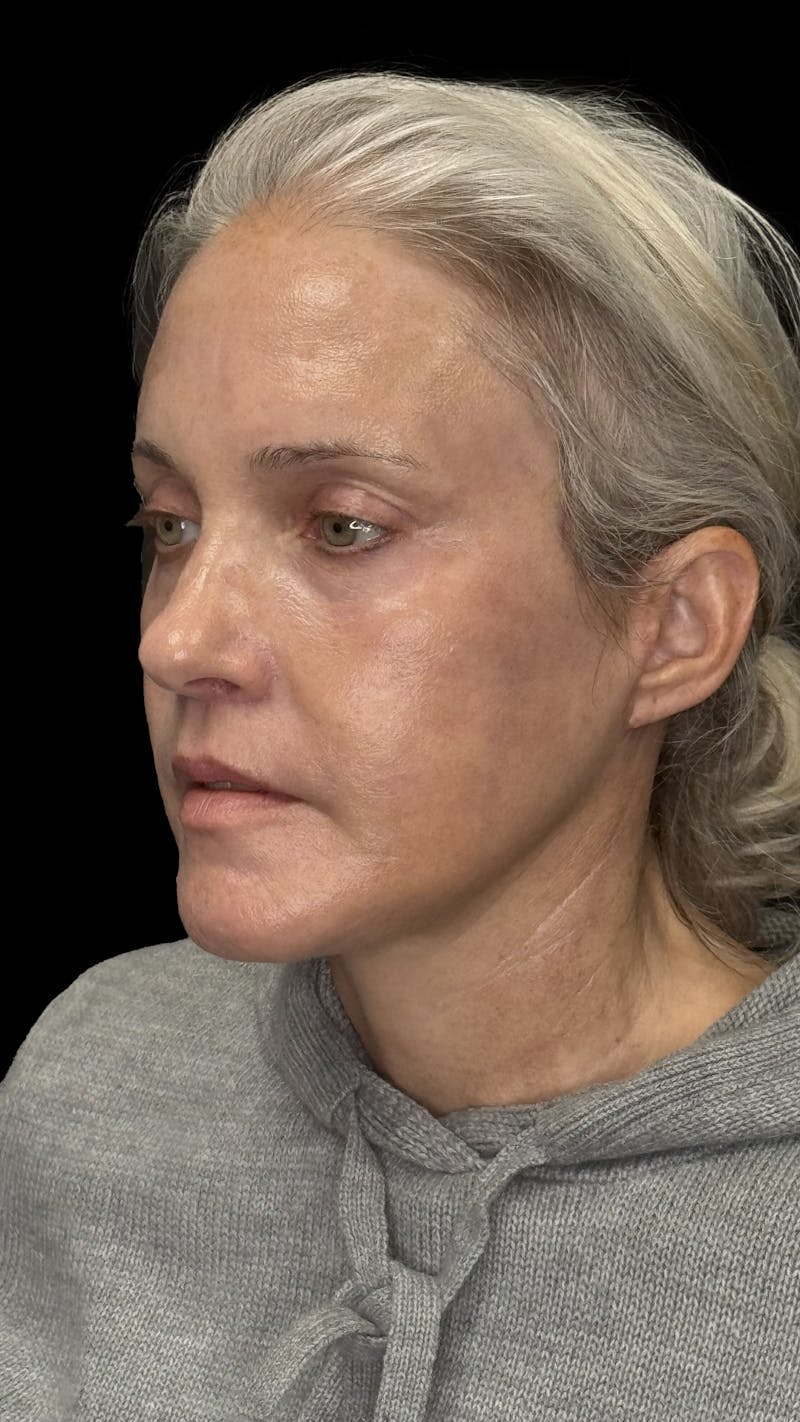 ContourLift Before & After Gallery - Patient 331359 - Image 4