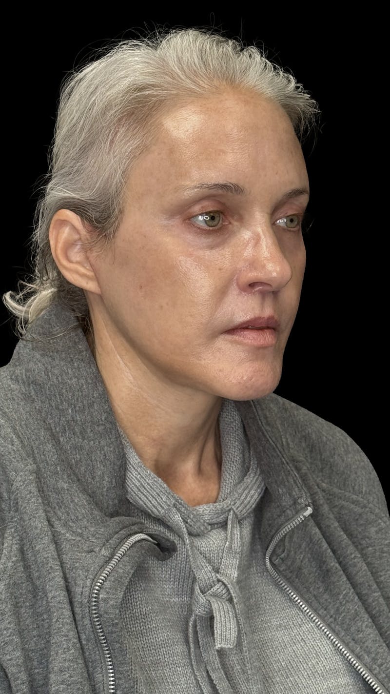 ContourLift Before & After Gallery - Patient 331359 - Image 12