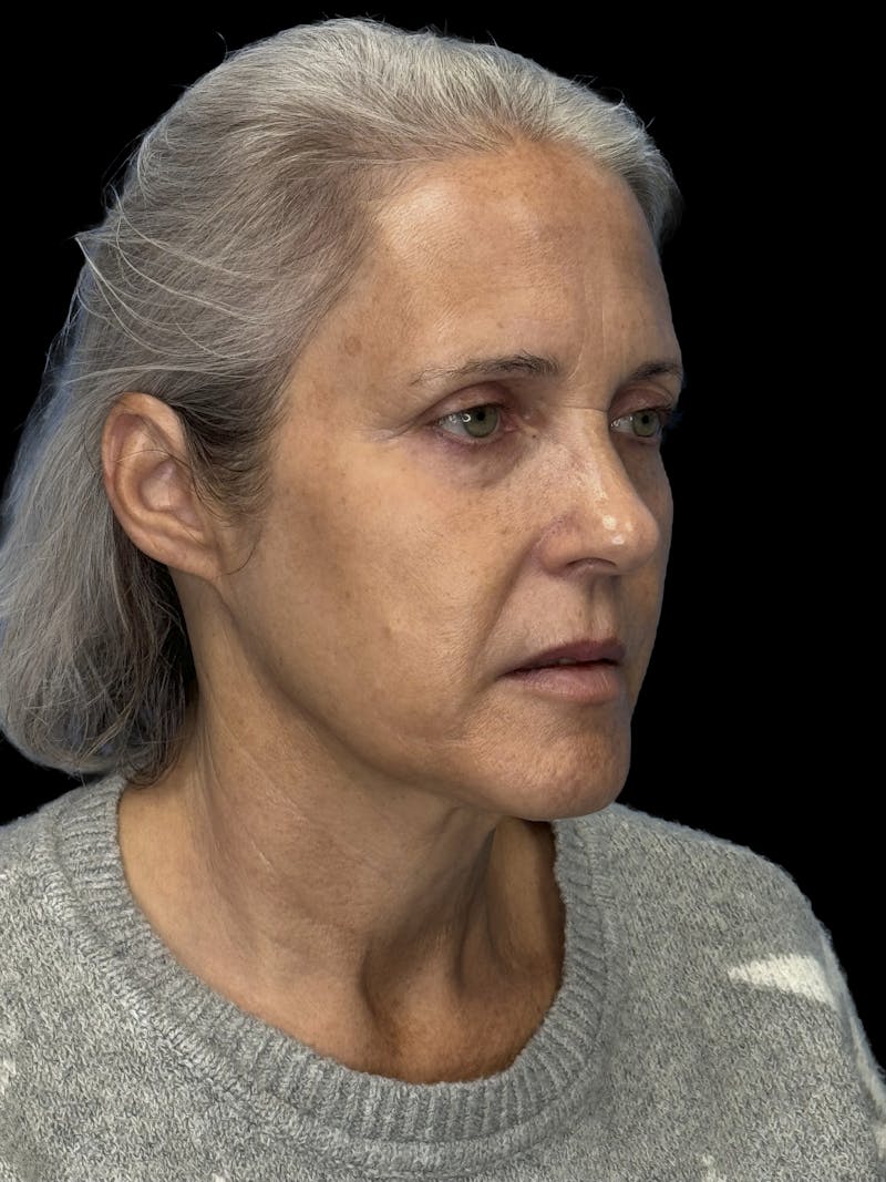 ContourLift Before & After Gallery - Patient 331359 - Image 11
