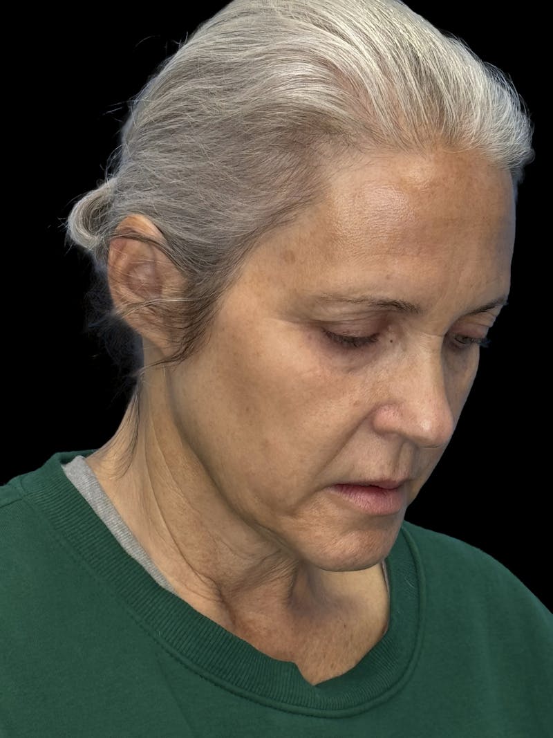 ContourLift Before & After Gallery - Patient 331359 - Image 9